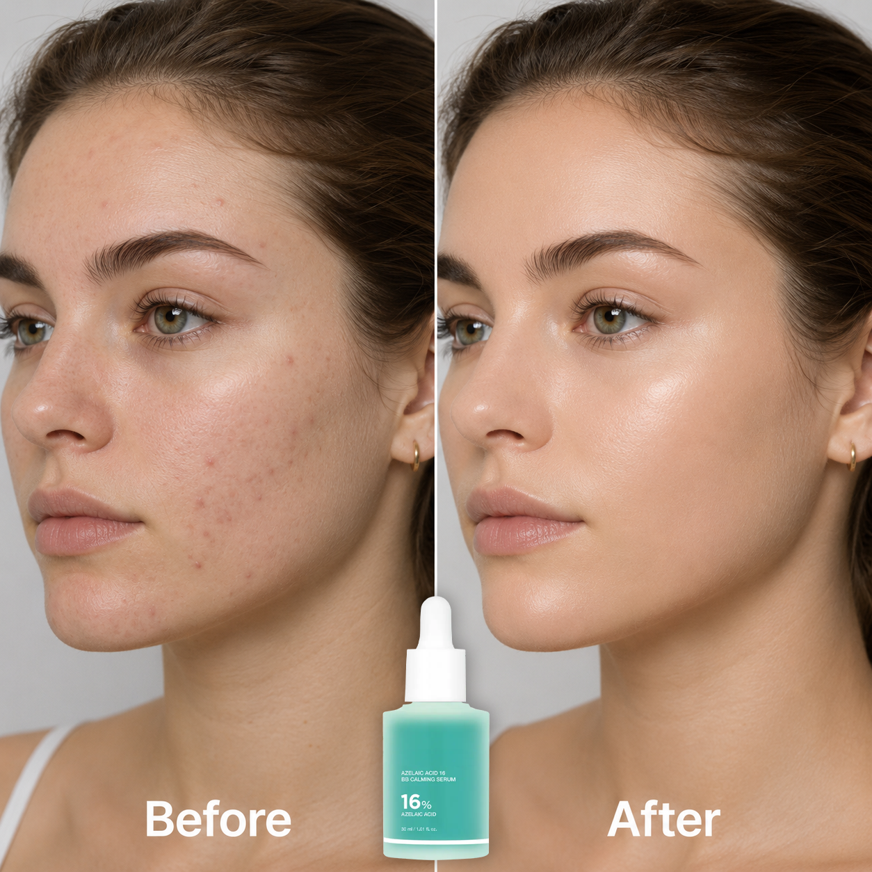 🔥 Buy 1 Get 1 Free✨16% Azelaic Acid Calming Serum with Niacinamide and Vitamin B5