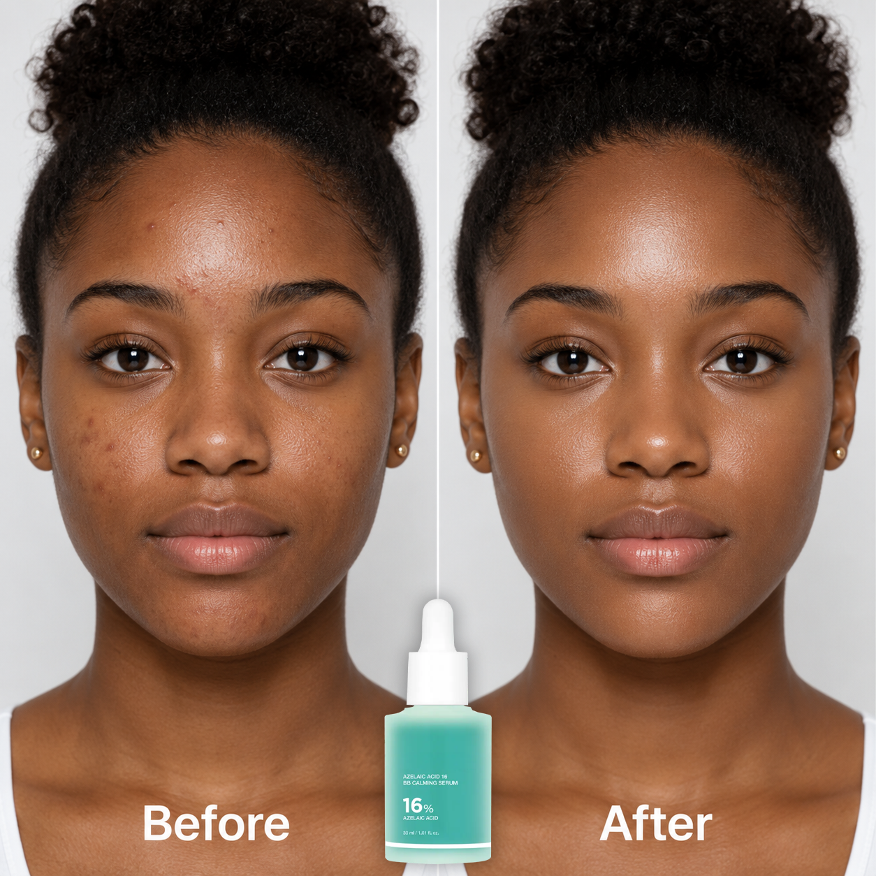 🔥 Buy 1 Get 1 Free✨16% Azelaic Acid Calming Serum with Niacinamide and Vitamin B5