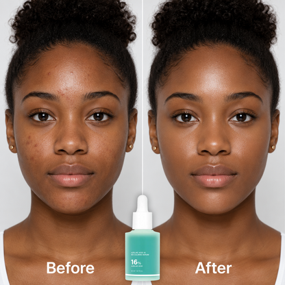 🔥 Buy 1 Get 1 Free✨16% Azelaic Acid Calming Serum with Niacinamide and Vitamin B5