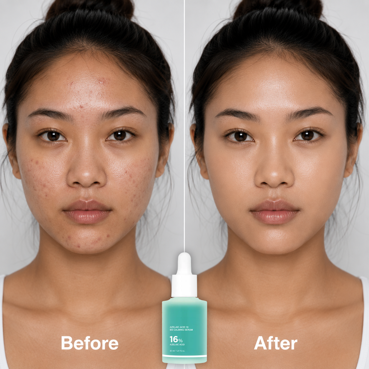 🔥 Buy 1 Get 1 Free✨16% Azelaic Acid Calming Serum with Niacinamide and Vitamin B5